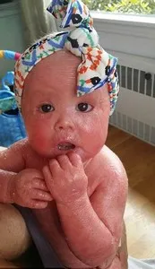 harlekin ichthyosis