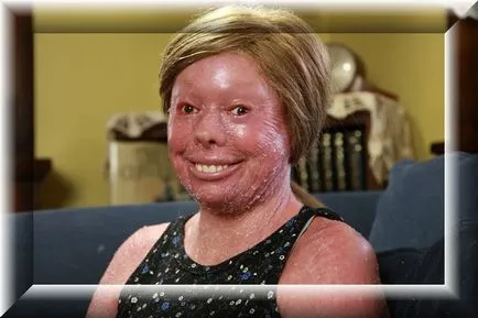 Harlequin ichthyosis - Kezelés és fotók