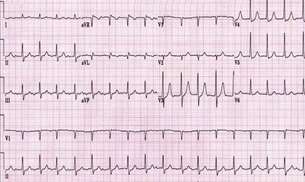 Hogyan lehet az EKG