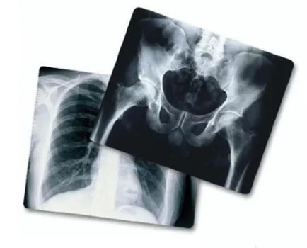Milyen gyakran és hányszor lehet csinálni egy x-ray (tudod) Milyen gyakran és hányszor lehet csinálni egy x-ray