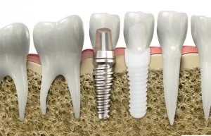 Mi jobb fogak implantátumok (implantátumok)