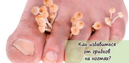 Hogyan lehet megszabadulni a gomba a köröm lábak