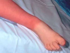Hogyan kell kezelni egy arc a lábán otthon népi jogorvoslati