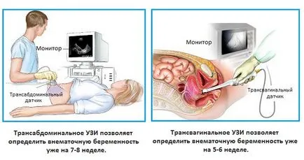Hogyan lehet azonosítani a méhen kívüli terhesség korai szakaszában a korai szakaszában a diagnózis és érzékelés (határozza meg) Hogyan lehet azonosítani a méhen kívüli terhesség korai szakaszában a diagnózis és a kimutatási korai szakaszában