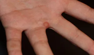 Hogyan lehet megkülönböztetni egy anyajegy a fő jellemzői a szemölcsök