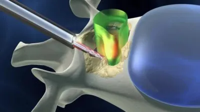 Spinalis stenosis (degeneratív, abszolút relatív), hogy ez (csigolya) Spinalis stenosis (degeneratív, abszolút relatív), hogy