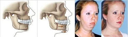 Módszerek harapás korrekció gyermekeknél - módszer leírása (gyermek) Módjai kijavítása malocclusion gyermekeknél - módszer leírása