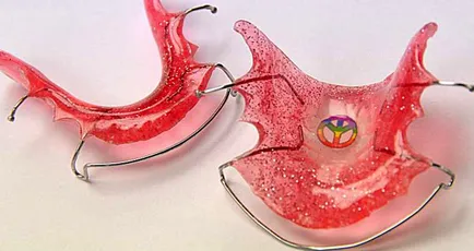 Módjai kijavítása malocclusion gyermekeknél - módszer leírása (korrekció) Módjai kijavítása malocclusion gyermekeknél - módszer leírása