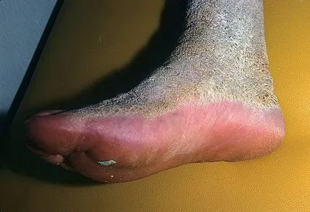 Hogyan működik a betegség ichthyosis harlekin (tünetek) Hogyan működik a betegség ichthyosis harlekin