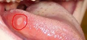Stomatitis okoz, mitől és miért tűnik
