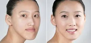 Az ára kijavítása malocclusion felnőttek sebészeti (műtéti harapás korrekciós érték) Az ára harapás korrekciója műtét felnőtteknél