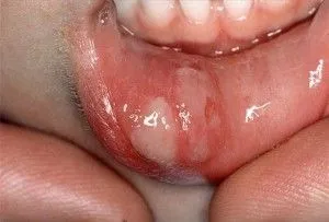 Stomatitis okoz, mitől és miért tűnik