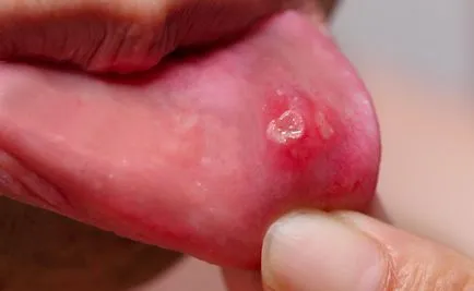 Stomatitis tünetei, okai, kezelése szájpenész felnőtteknél (fotók) Stomatitis tünetei, okai, kezelése szájpenész felnőtteknél