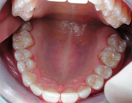 Hogyan védi a fogakat a fogszuvasodás és hogy megelőzzék az előfordulását (caries) Hogyan védi a fogakat a fogszuvasodás, és megakadályozzák annak előfordulását
