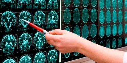 Stem löket - mi ez, tünetei, diagnózisa és kezelése elváltozások a fej az agytörzs