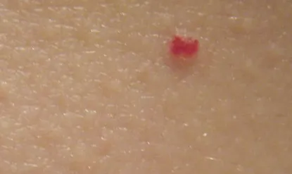 Vörös foltok a testen képek, okoz, kezelés, bőrbetegség (fotó) Vörös foltok a testen képek, okok, kezelés, bőrbetegségek