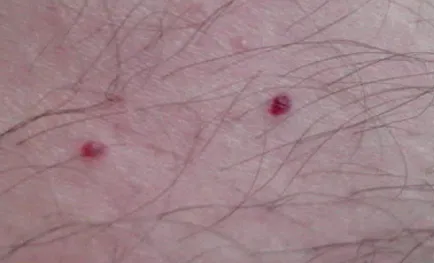Vörös foltok a testen képek, okoz, kezelés, bőrbetegség (piros) Vörös foltok a testen képek, okok, kezelés, bőrbetegségek