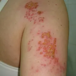 Herpesz népi jogorvoslati (herpes kezelések) Herpesz kezelése népi jogorvoslati