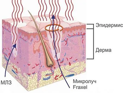 Fraxel Laser (Fraxel) mi az, típusok, működési elve, előnyei ár