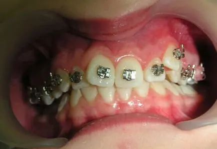 Top zárójelben vagy mi jobb, hogy fogszabályozó