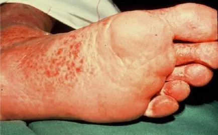Mycosis fényképet megáll, tünetek, kezelés