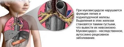 A cisztás fibrózis a gyermekek tünetek és a kezelés
