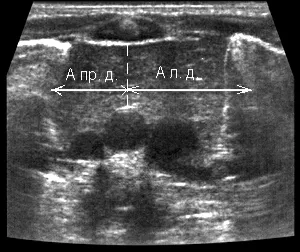Uzi norma csecsemőmirigy méretére