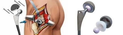 Áttekintés csípőprotézis árak, kiválasztási kritériumok, jelzések arthroplasty (közös) Áttekintés csípőprotézis árak, kiválasztási kritériumok, jelzések arthroplasztikát