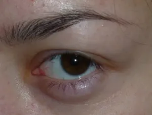 Alsó szemhéj duzzadt és fájdalmas okai és mi a teendő ilyen esetben,
