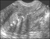 A patológia az endometrium ultrahang nőgyógyászati (csak ultrahang kritérium) A patológia az endometrium ultrahang diagnosztika Nőgyógyászati gyakorlatban