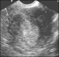 A patológia az endometrium ultrahang diagnosztika Nőgyógyászati gyakorlatban (variáns endometriális rák) A patológia az endometrium ultrahang diagnosztika Nőgyógyászati gyakorlatban