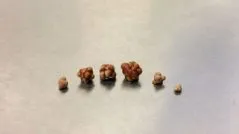 Sand vese - otthoni kezelés népi jogorvoslati (homok) A homok a vesében - otthoni kezelés népi jogorvoslati