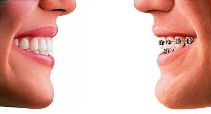 Beszéljünk arról, hogyan igazítsa a fogait otthon