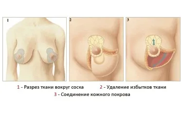Reduction mammoplasty javallatok, ellenjavallatok