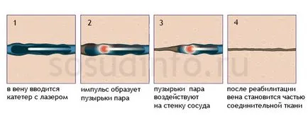 Teleangiectasia okok, kezelés, elhelyezés módszerek (napfényt) Teleangiectasia okok, kezelés, ártalmatlanítási módszereket