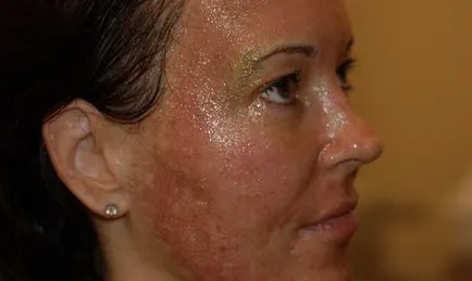 Miután peeling arca vörös és viszkető (fő) Miután peeling arca vörös és viszkető