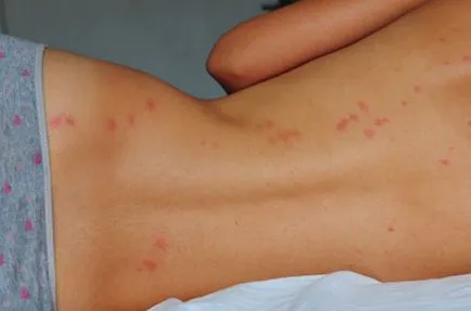Az okok a szisztémás vasculitis, a diagnózis és kezelés (oka) Az okok a szisztémás vasculitis, a diagnózis és a kezelés