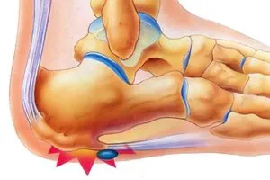 Ellenőrzött népi jogorvoslati kezelésére sarkantyú (Folk) Bizonyított hagyományos gyógymódokat kezelésére sarkantyú