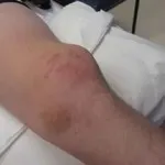Rehabilitáció után térdsérülése