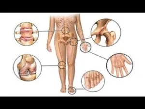 A recept a kezelésére gonarthrosis