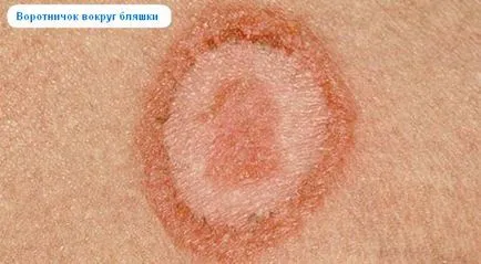 Pink zoster Gibert okoz tüneteket, fertőző vagy nem