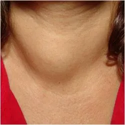 Tünetei pajzsmirigy (pajzsmirigy hormonok) Tünetei pajzsmirigy rendellenességek