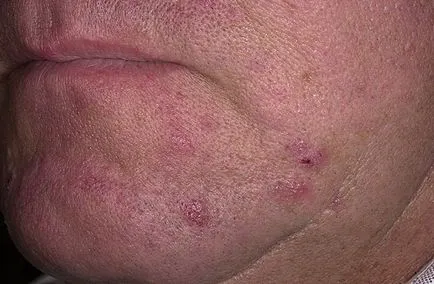 Szőrtüszőgyulladás formák, a tünetek, a megelőzés, kezelés, a szövődmények prognózisa (staphylococcus szőrtüszőgyulladás az arcon a gyermekek) Szőrtüszőgyulladás formák, a tünetek, a megelőzés, kezelés, a szövődmények prognózisa