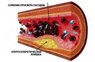 Sclerosis az aorta, amely, az okok, tünetek, kezelés (szklerózis) Sclerosis az aorta, amely, az okok, tünetek, kezelés