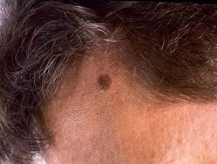 Hány élő melanomás túlélési prognózisa alapján szakaszában (melanoma) Hány élő melanomás túlélési prognózist illetően a színpadon