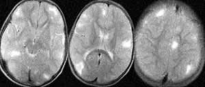 Sclerosis tuberosa tünetek, kezelés, a várható élettartam