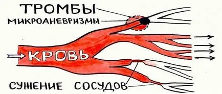 A vérrög a szívében mi ez, tünetei és kezelése (tünetek) A vérrög a szívében mi ez, tünetei és kezelése