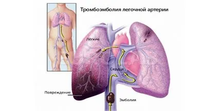 A vérrög a szívében mi ez, tünetei és kezelése (kezelés) A vérrög a szívében mi ez, tünetei és kezelése
