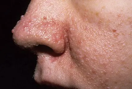 Sclerosis tuberosa tünetek, kezelés, a várható élettartam