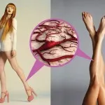 Trombózis a mély vénák (trombózis) Thrombosis a mély vénák az alsó végtagok